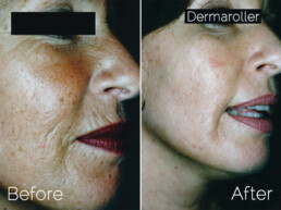Genuine Dermaroller treatement before and after