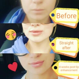 Filler lip treatment