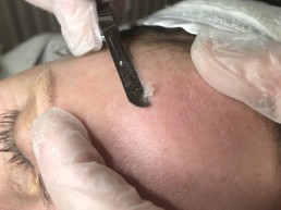 Dermaplaning in Poole