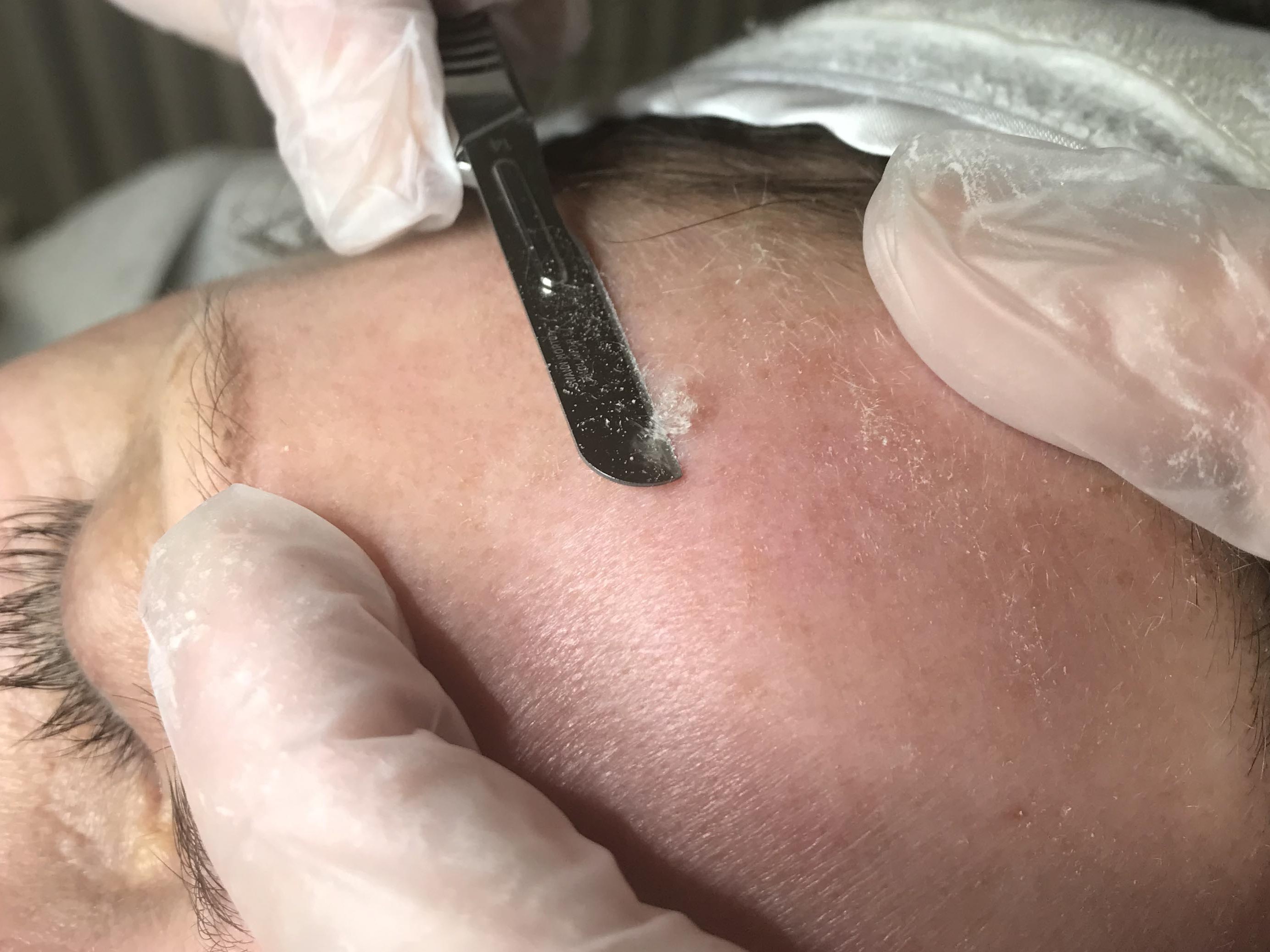 Dermaplaning in Poole