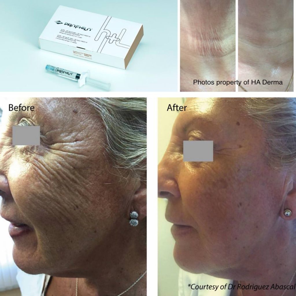 Profhilo & Structura - The Harbourside Clinic | Poole