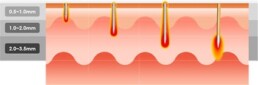 Secret RF Needle Depth