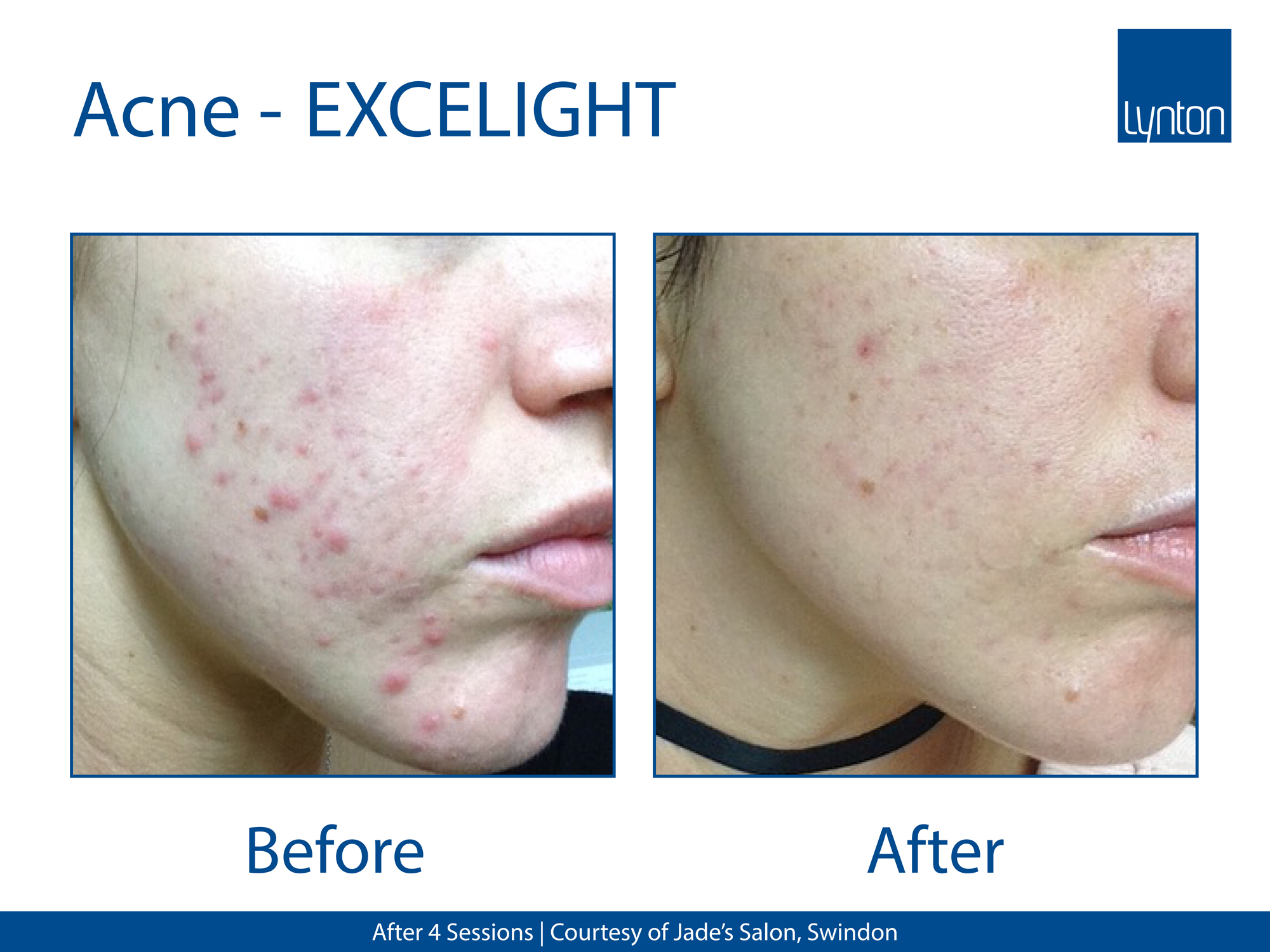 Acne-EXCELIGHT-Poole-Clinic